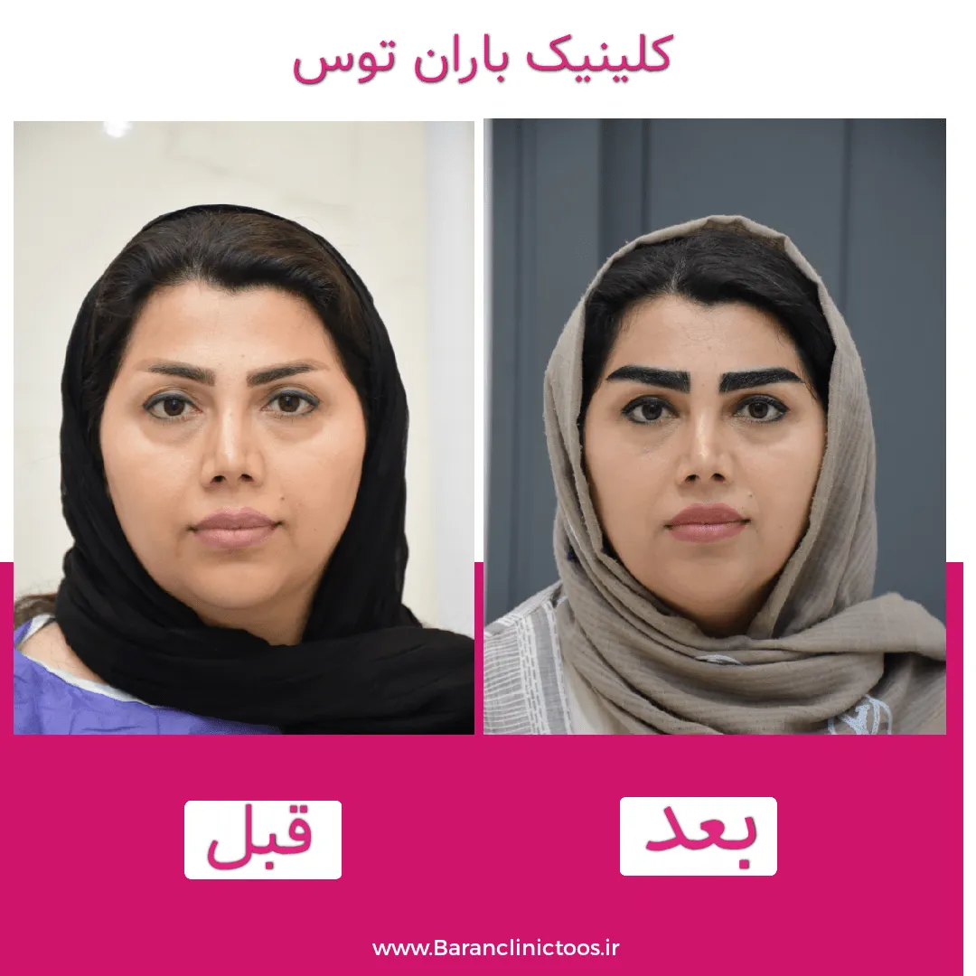 قبل و بعد کاشت ابرو
